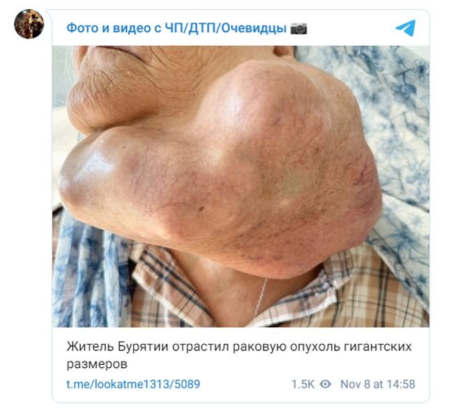 огромная опухоль